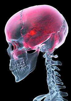 Headache, X-ray artwork Headache, X-ray artwork