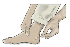 Digital illustration of man using sterilized needle to pierce blister on foot Digital illustration of man using sterilized needle to pierce blister on foot